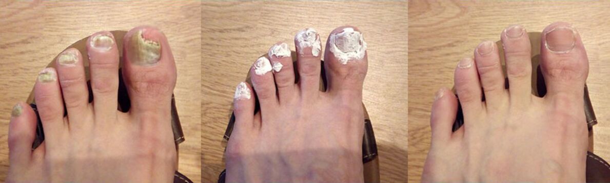 Rezultatul tratamentului ciupercii folosind Funget