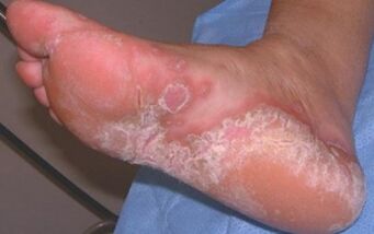 Dermatomicoza acută a piciorului