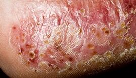Dermatomicoză