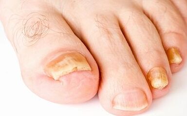 Simptome foto ale ciupercii de unghii