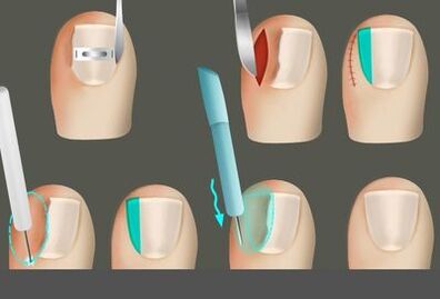 Îndepărtând unghia în prezența unei ciuperci pe picioare