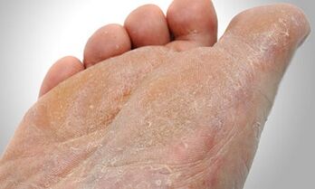 Căi de transmisie a ciupercilor pentru picior