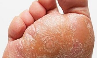 Semne și simptome ale ciupercii pe picioare